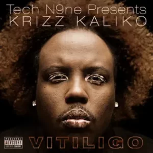 Vitiligo-Krizz-Kaliko